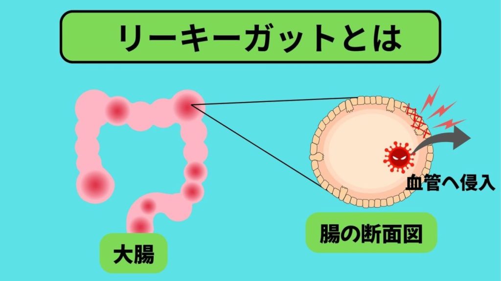 リーキーガットとは